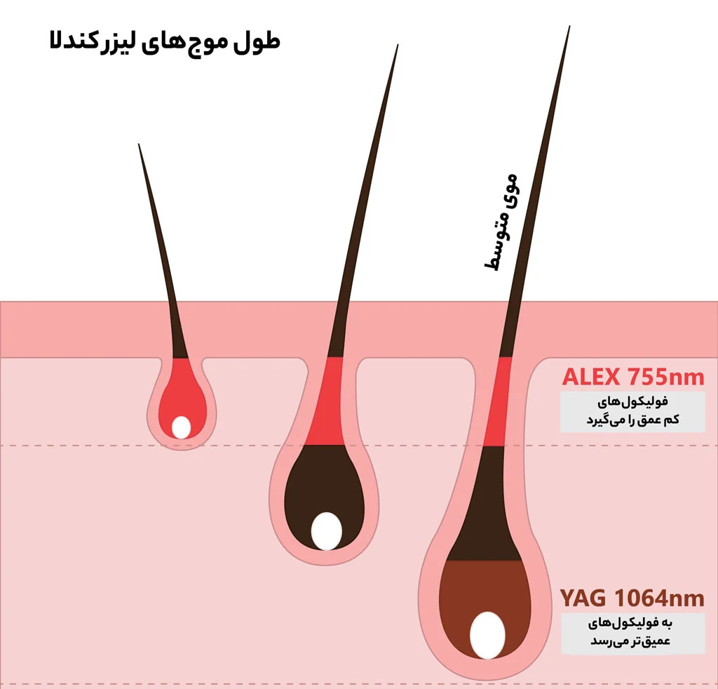 طول موج لیزر کندلا