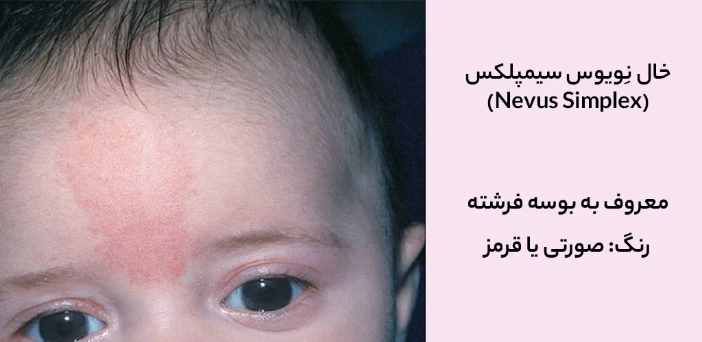 خال نِویوس سیمپلکس (Nevus Simplex) یا بوسه فرشته