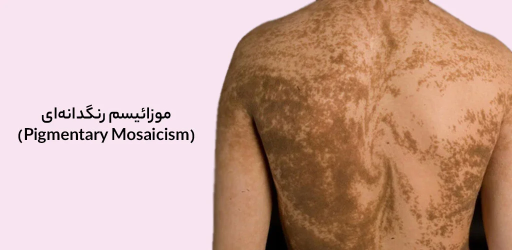 موزائیسم رنگدانه‌ای (Pigmentary Mosaicism)