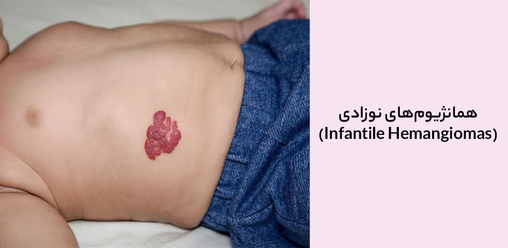 همانژیوم‌های نوزادی (Infantile Hemangiomas)