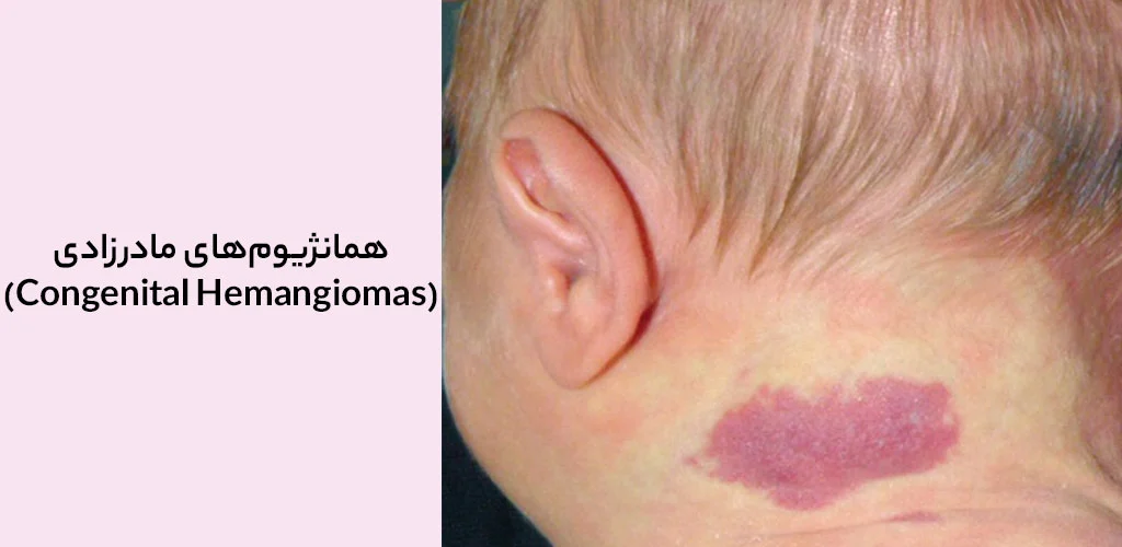 همانژیوم‌های مادرزادی (Congenital Hemangiomas)