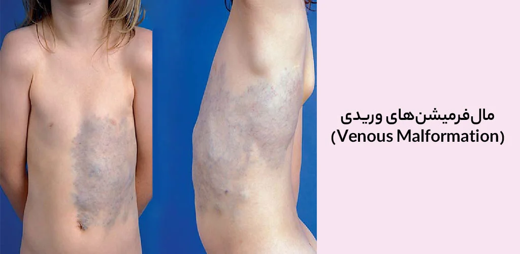 مال‌فرمیشن‌های وریدی (Venous Malformation)