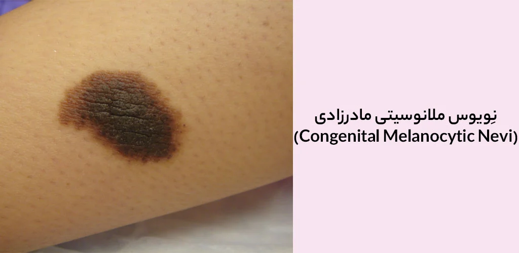 نِویوس ملانوسیتی مادرزادی (Congenital Melanocytic Nevi)