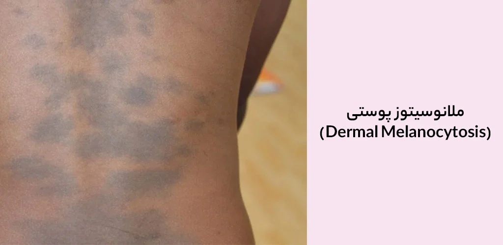 ملانوسیتوز پوستی (Dermal Melanocytosis)